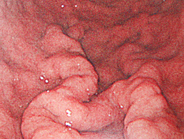 ピロリ菌感染胃