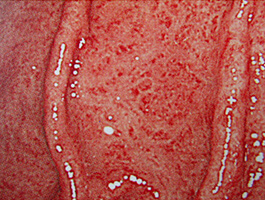 ピロリ菌感染胃